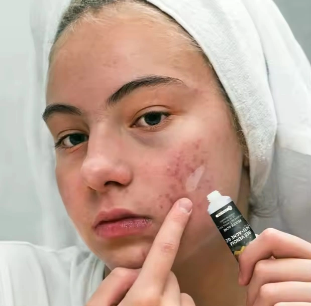 Acne Removing Ointment